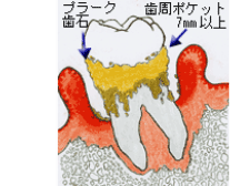 歯周ポケット