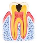 穴が象牙質にまで拡大している状態