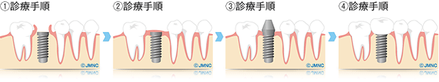 治療手順